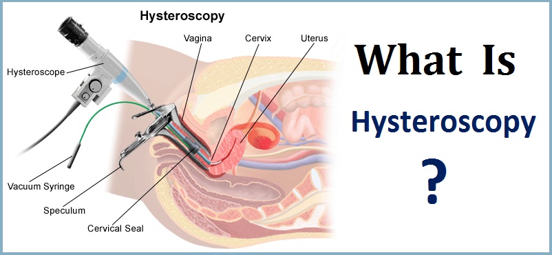 What is Hysteroscopy